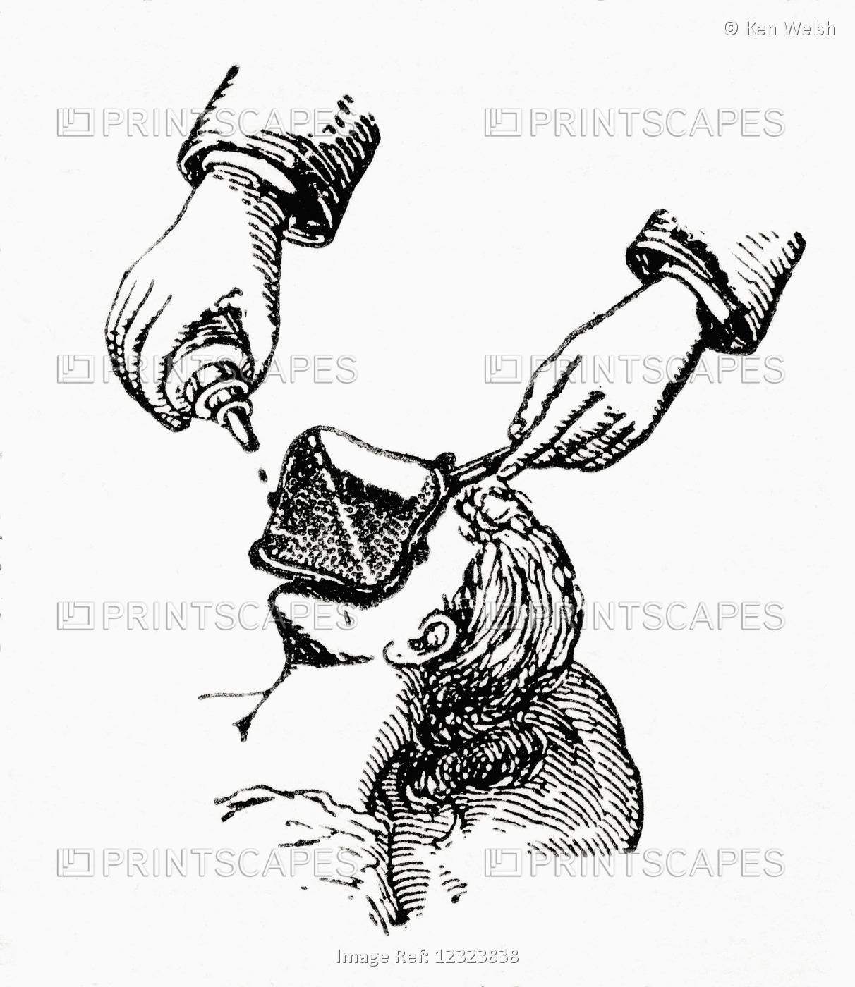 Anaesthetizing A Patient In The Late 19th Century By Dripping Chloroform Onto A ...